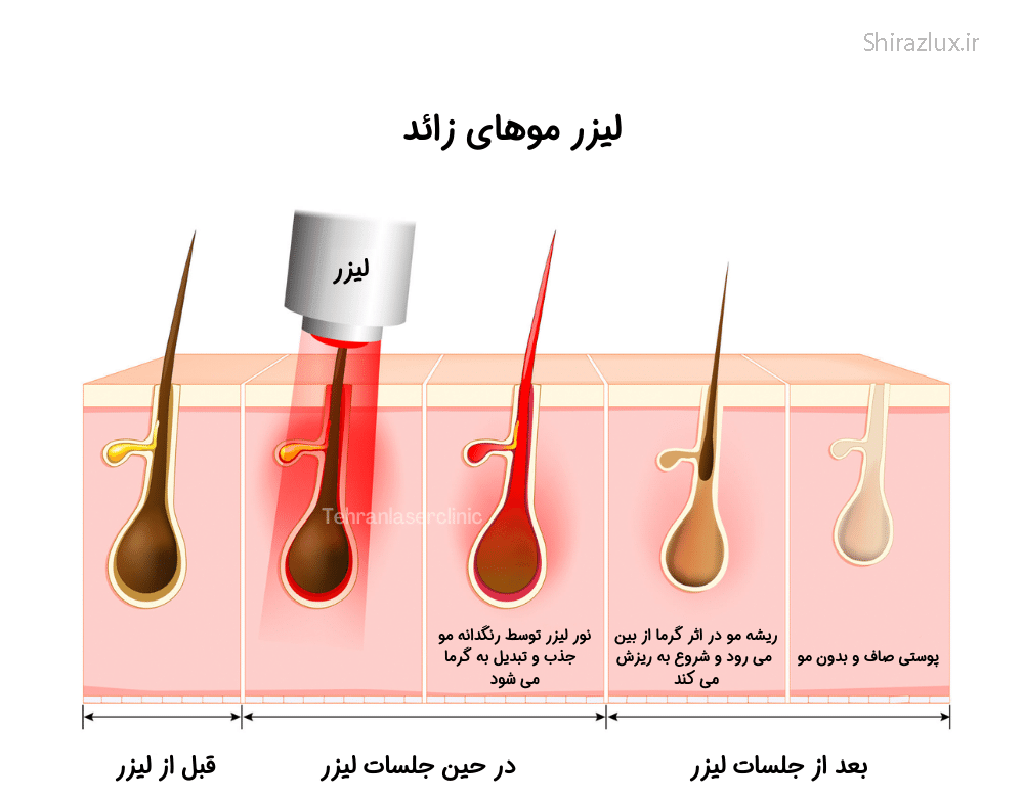 مرکز لیزر شیراز