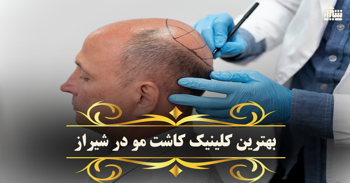 بهترین کلینیک کاشت مو در شیراز