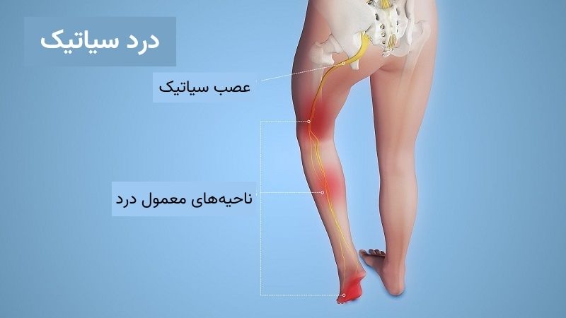 بهترین دکتر سیاتیک در شیراز