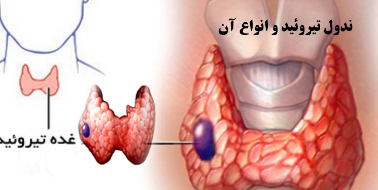 بهترین فوق تخصص غدد تیروئید شیراز